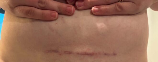 C-Section Scar